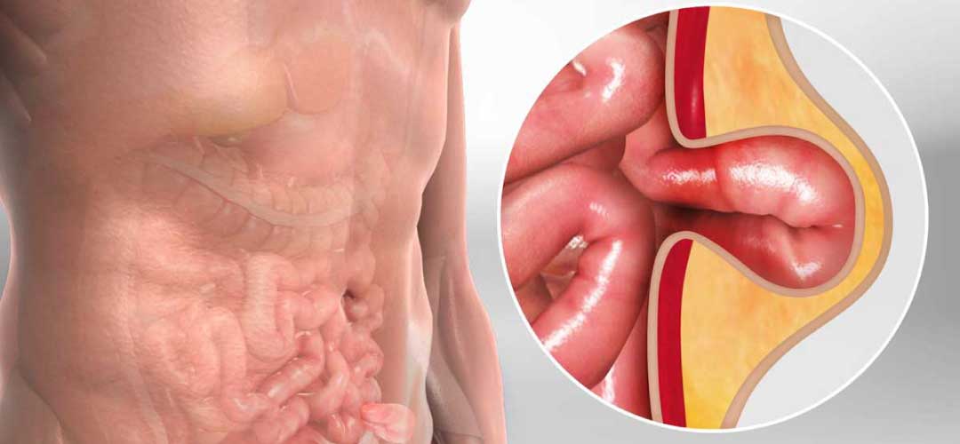 Hernia & Varikokel