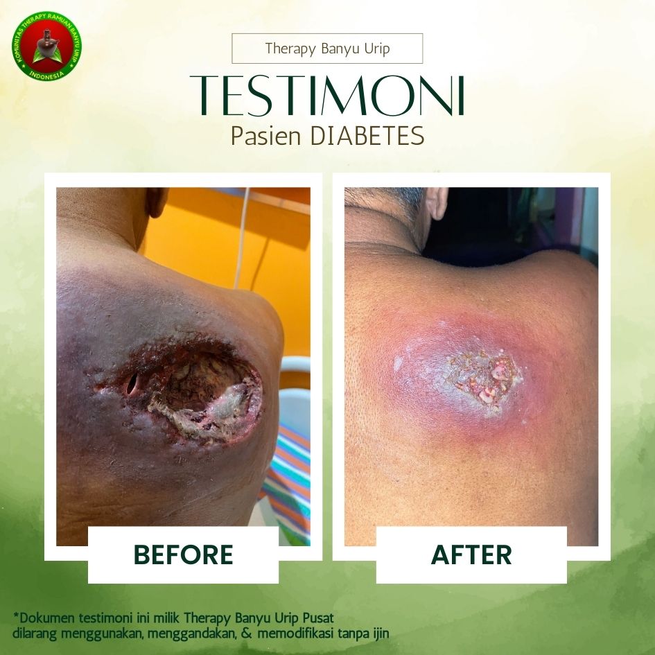 Gal-1-Diabetes