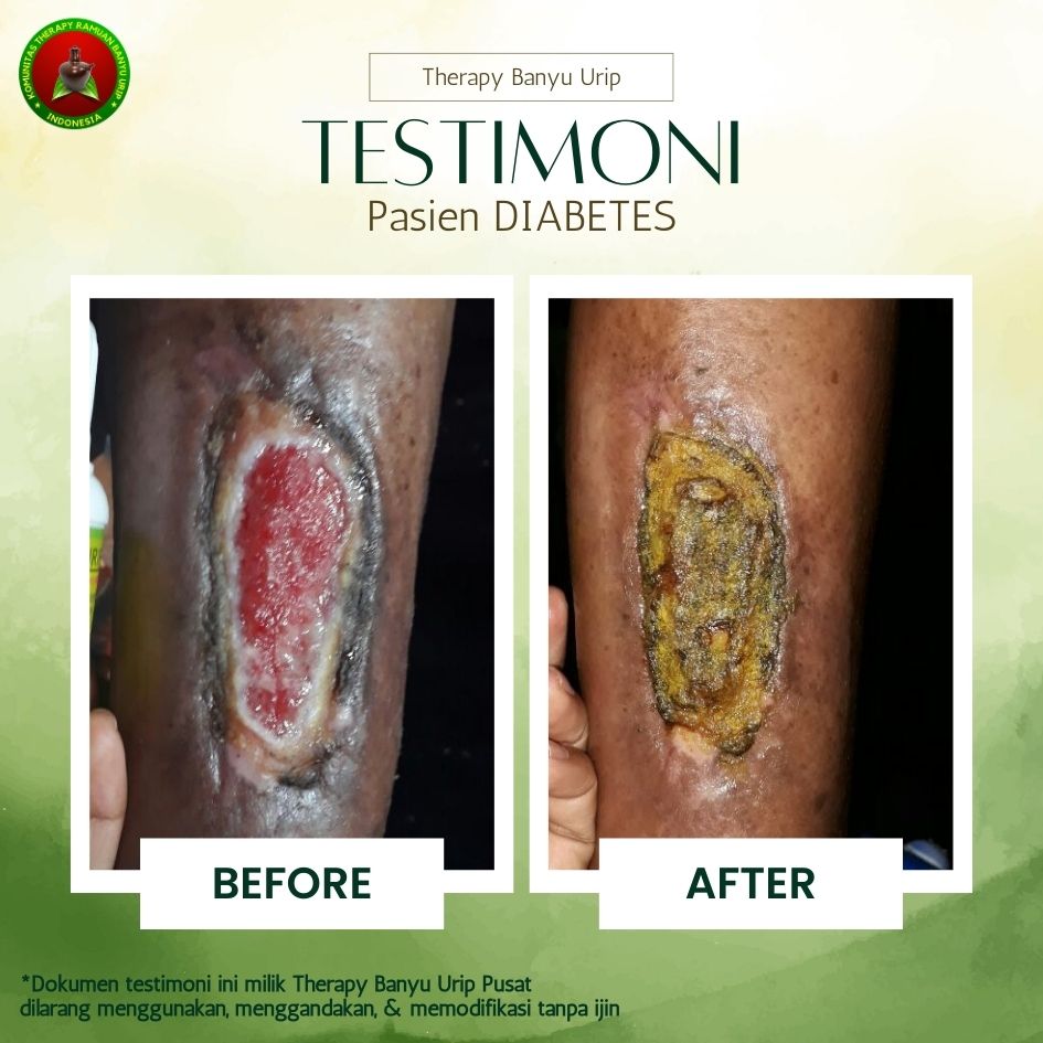 Gal-2-Diabetes