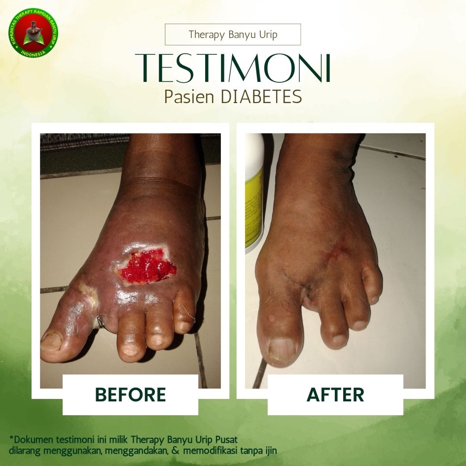 Gal-3-Diabetes