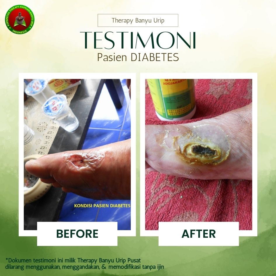 Gal-4-Diabetes